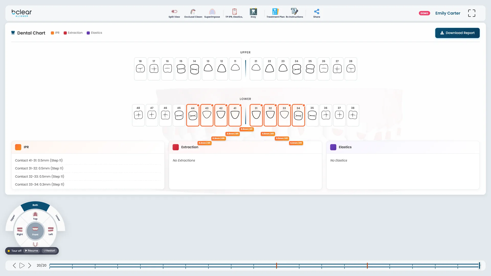 PlanStudio dental chart with IPR per contact, extractions and elastics.