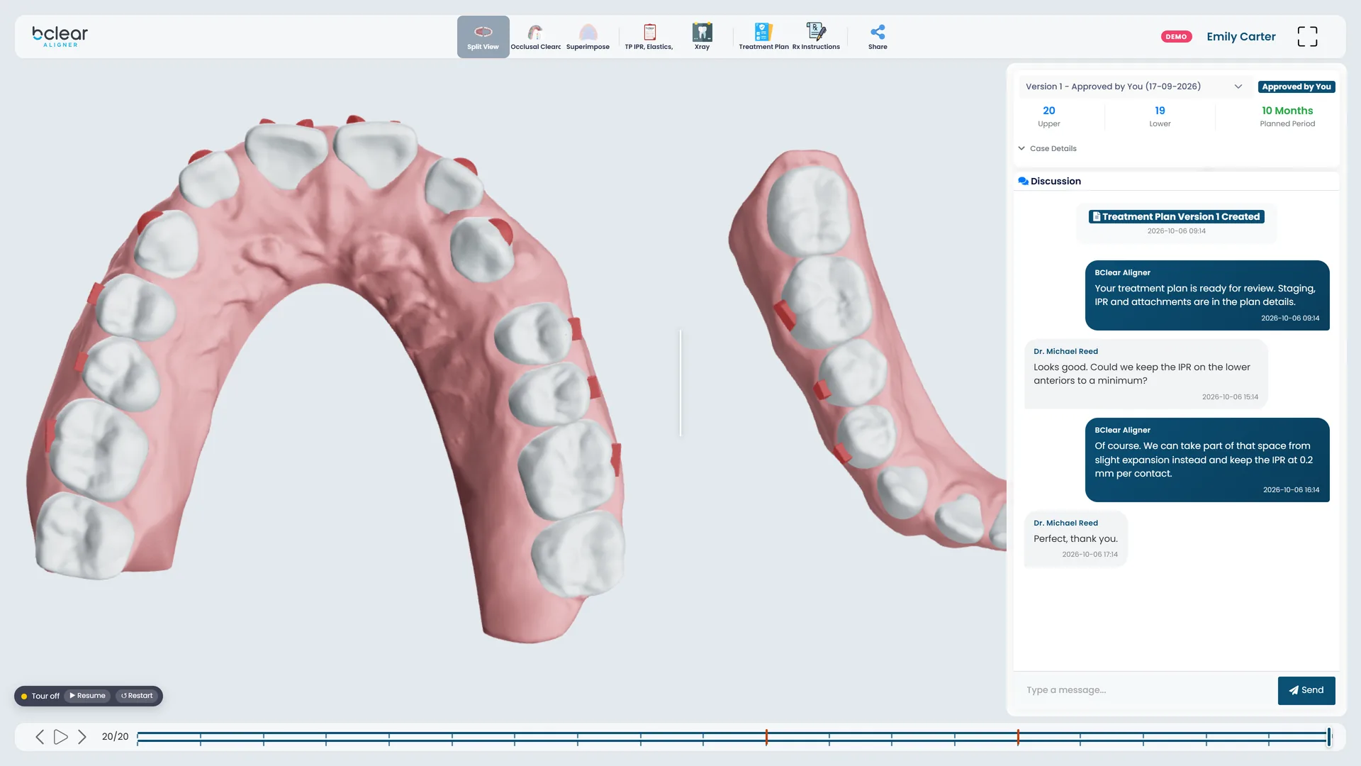PlanStudio split view: the upper and lower arches of a sample case side by side, with attachments.